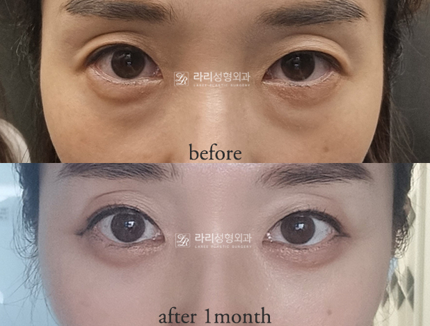 [Lari Plastic Surgery] For Bulging Under-Eyes That Eye Bag Creams / Eye Bag Patches Can’t Fix: Lower Eyelid Fat Repositioning! image 6