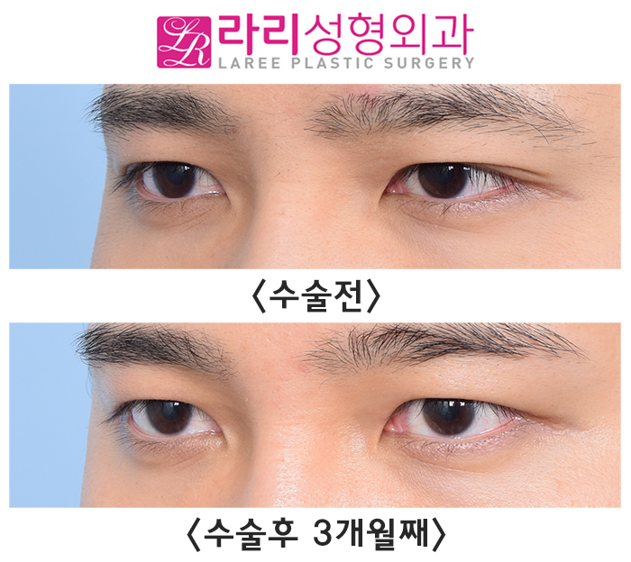 [라리성형외과] 자연쌍꺼풀없애기 수술 전후 사진 회복 기간 짝눈 교정 관련 이미지 5