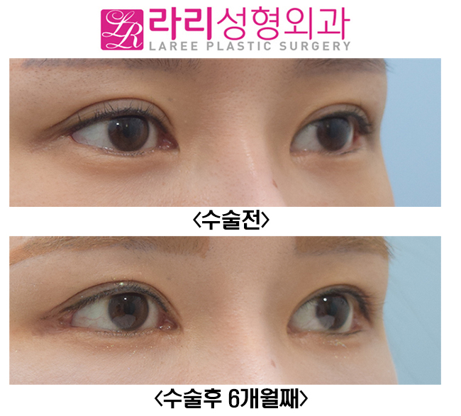 [Rari Plastic Surgery] Eyelid Surgery That Suits Me / Revision Double Eyelid Surgery, Revision Epicanthoplasty, Revision Lateral Canthoplasty image 3