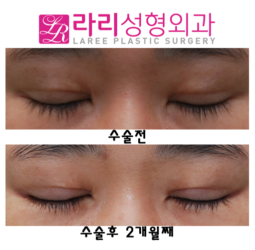 비절개눈매교정술과 뒤트임재수술 함께 한다면 관련 이미지 5