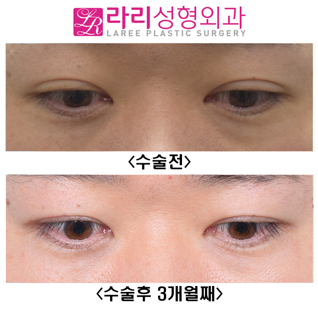 [Lari Plastic Surgery] Lowering the Line of Thick Natural Double Eyelids to a Deep-Eye Style That Looks Like No Double Eyelids image 3