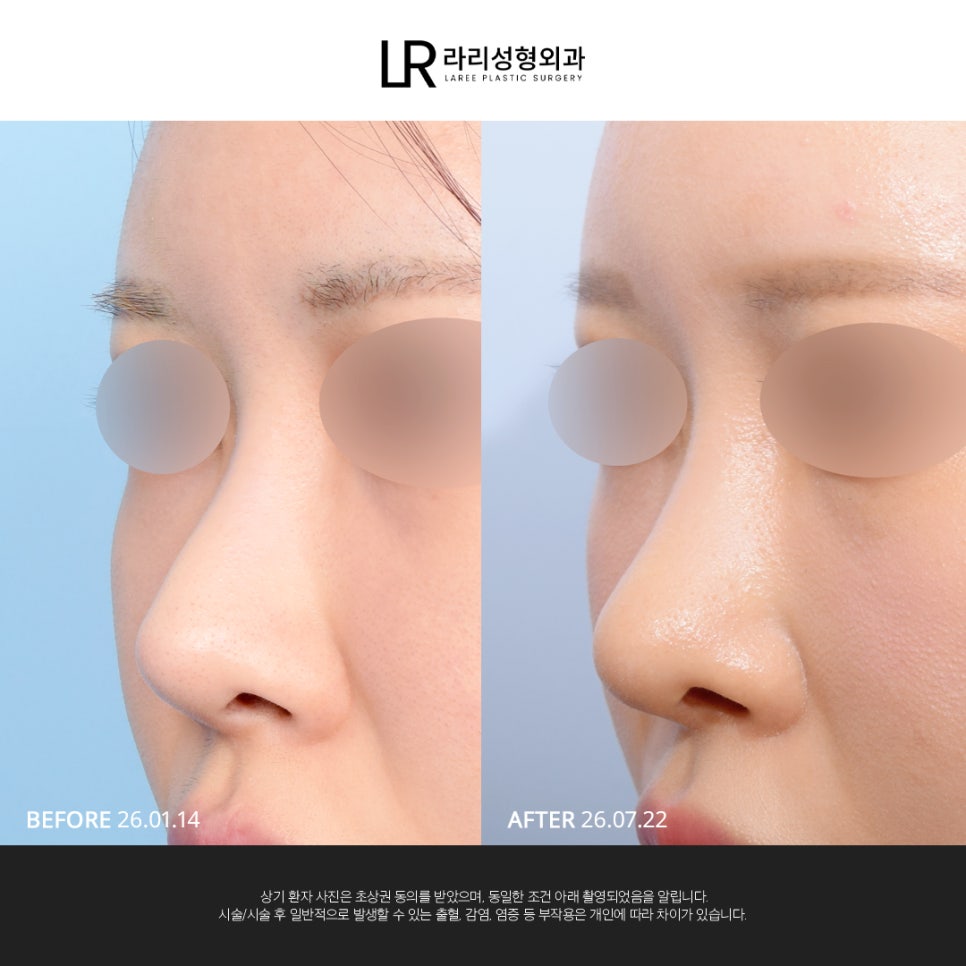 [LARI Plastic Surgery] Structural Line Rhinoplasty Revision Connecting the Nasal Bridge, Dorsum, and Tip image 5