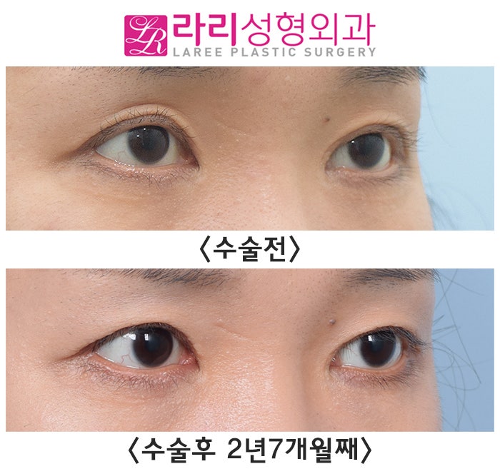 [Lari Plastic Surgery] Before-and-After Photos of Double Eyelid Removal Surgery to Correct Eyelash Eversion image 1