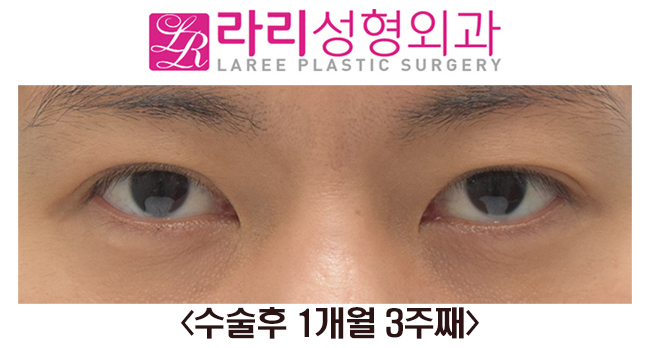 [Rari Plastic Surgery] Before and After Right Non-incisional Double Eyelid Reoperation image 2