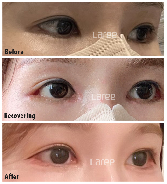 [라리성형외과] 탁 트인 눈을 위한 뒤트임 수술 전 알아야 할 핵심 키워드 완전정복 관련 이미지 4