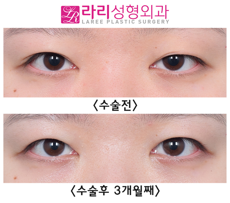[라리성형외과] 쌍꺼풀없애는수술에 대하여 관련 이미지 1