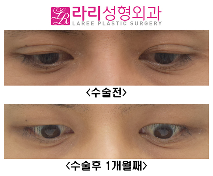 [라리성형외과] 눈크기 짝짝이 교정 수술 전후사진 관련 이미지 4