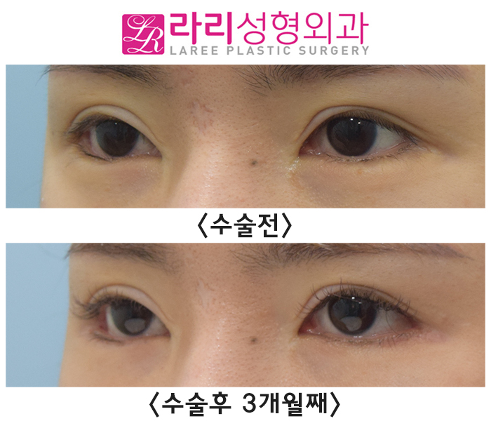 [라리성형외과] 완성도 높은 뒤트임수술을 위해 애교이식지방은 제거해 주세요. (필요시 안검내반수술을 함께) 관련 이미지 2