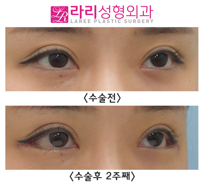 [라리성형외과] 뒤트임수술, 결막부종이 없는 경우 단기경과 (수술 전후 2주째) 관련 이미지 1