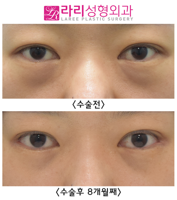 [라리성형외과] 뒤트임수술과 눈밑지방재배치 함께 하면 좋은 수술 best 관련 이미지 3