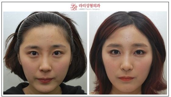 Lateral Canthoplasty / Outer Corner Canthoplasty / Outer Eye Corner Lowering Canthoplasty Before and After Photos image 1