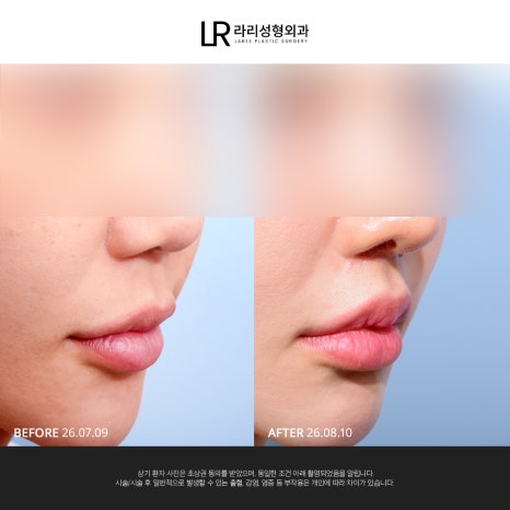 [라리성형외과] 사진 찍으면 유독 길어 보이는 인중, 인중축소로 달라질 수 있을까? 관련 이미지 9