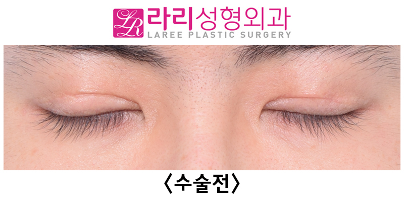 [라리성형외과] 쌍꺼풀없애기 수술 눈안감김(토안)의 원인이 정말 피부절제 때문일까? - 무절제쌍꺼풀없애기 관련 이미지 11