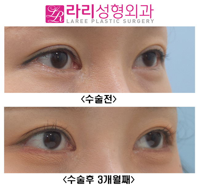 [Lari Plastic Surgery] If You Want to Be Sure of the Effect of Revision Lateral Canthoplasty, Do It Together with Revision Double Eyelid Surgery (Ptosis Correction Surgery). image 3