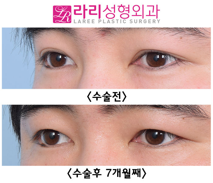 [라리성형외과] 자연쌍꺼풀 비대칭 교정 쌍꺼풀없애기 수술 전후 사진 관련 이미지 3