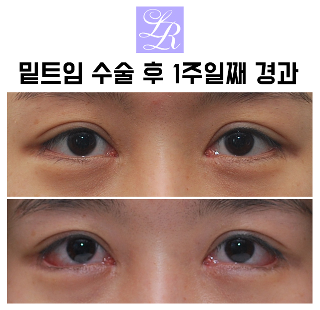 If You Want an S-Line Under Your Eyes, Try Lower Eye Widening image 9