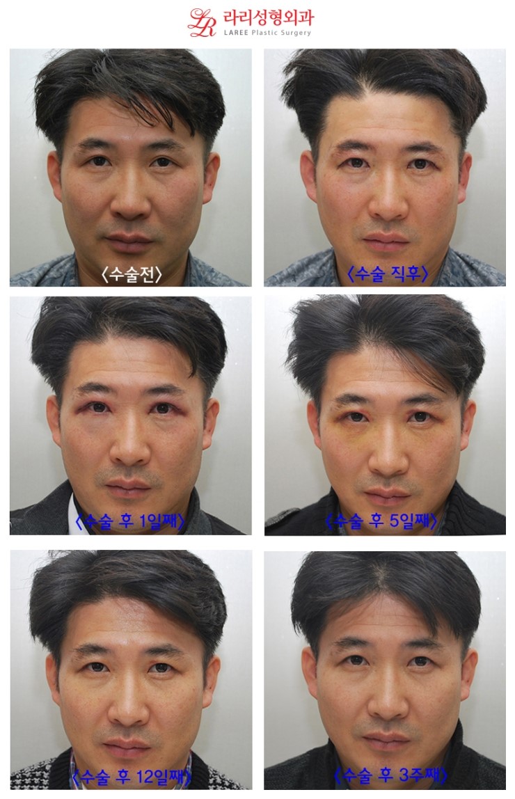 ☆남자는 홑꺼풀이 대세다!!! XTM 남자 쌍꺼풀 없애는 수술/쌍꺼풀 푸는 수술 전후사진 ☆ 관련 이미지 1