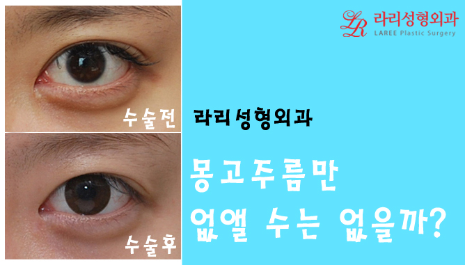 몽고주름, 더이상 헤매지말고 트임없는앞트임으로! 관련 이미지 3