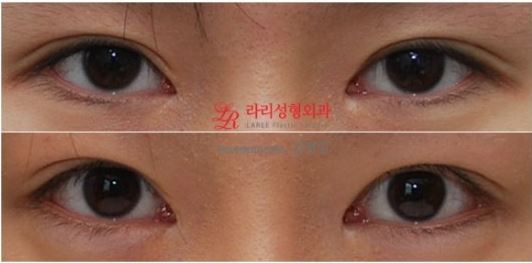 쌍꺼풀재수술/쌍꺼풀눈매교정재수술 전후사진 관련 이미지 1