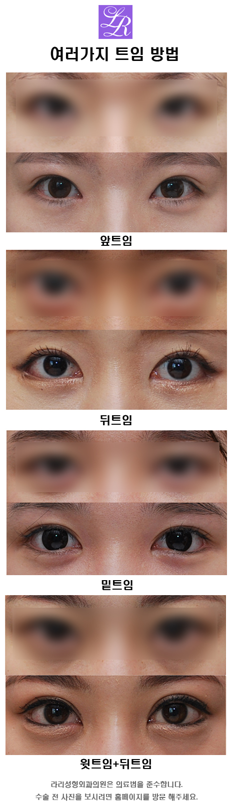 Lowering Upturned Outer Corners, Barbie Doll Lower Eye Widening image 1