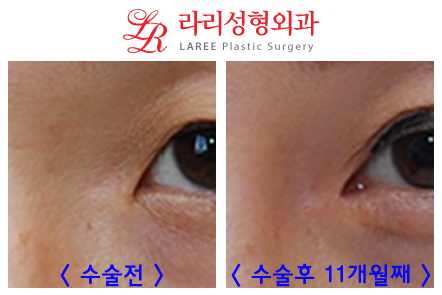 Epicanthoplasty: Is It Worth the Cost? image 3