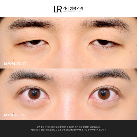 [라리성형외과] 눈 (재) 수술은 라리성형외과가 관련 이미지 2