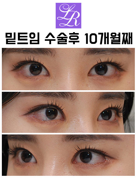 듀얼트임? 뒷트임? 밑트임? 수술 효과 및 재발가능성 관련 이미지 4
