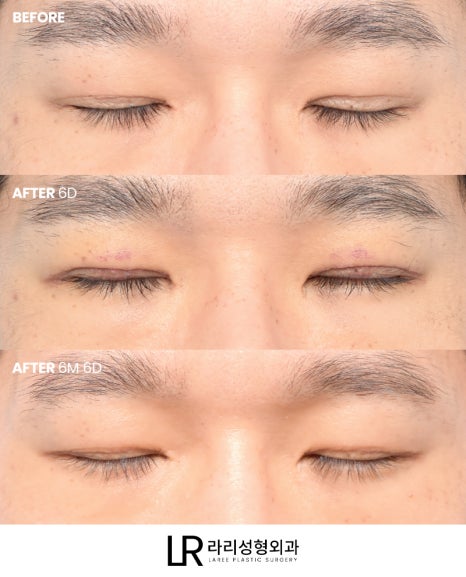 [Lari Plastic Surgery] Swelling After Double Eyelid Surgery: Why Does It Go Down Differently on Each Side? Will It Eventually Even Out? image 6
