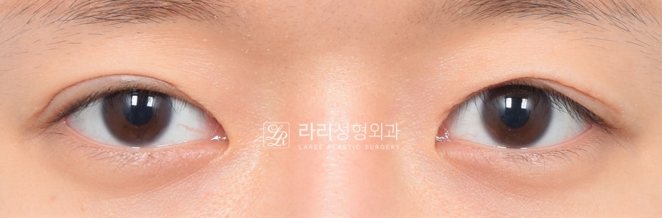 [라리성형외과] 안검하수 눈의 눈매교정이 어려운 이유 ?!! (Point ; 헤링의 법칙) 관련 이미지 1