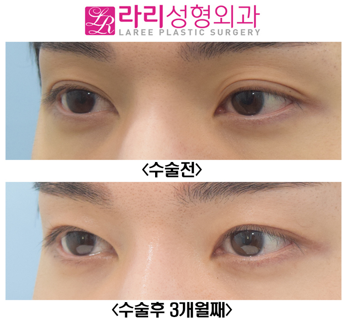 [라리성형외과] 졸려 보이는 자연쌍꺼풀, 아웃라인을 무쌍에 가까운 속쌍꺼풀로 또렷하게 만들기 관련 이미지 3