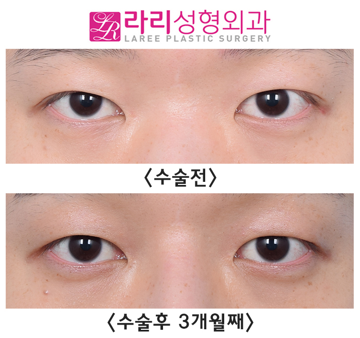 [라리성형외과] 고르지 못한 쌍꺼풀 라인의 개선을 위한 쌍꺼풀 지우는 수술 전후 사진 관련 이미지 1