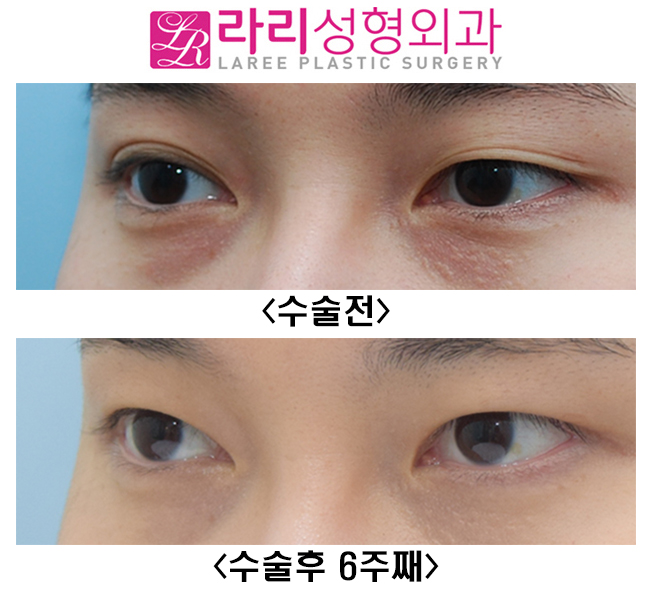 [Lari Plastic Surgery] Short-term progress after surgery to remove a natural double eyelid and make it monolid image 5