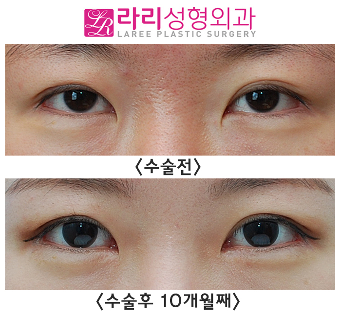 [라리성형외과] 트임없는앞트임, 분명 텄는데 터지지 않았습니다. 갈고리 몽고주름만 없앴습니다. 관련 이미지 1