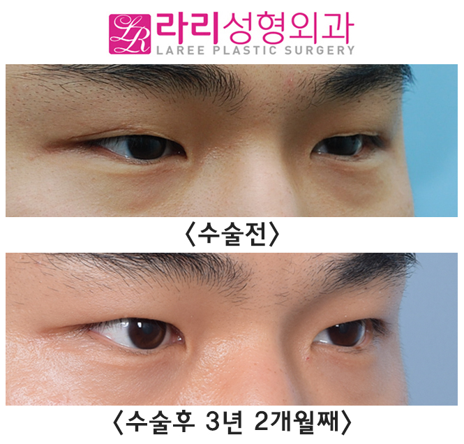 [라리성형외과] 절개 쌍꺼풀 부작용 풀림 현상 쌍꺼풀없애기 수술로 말끔하게 관련 이미지 2