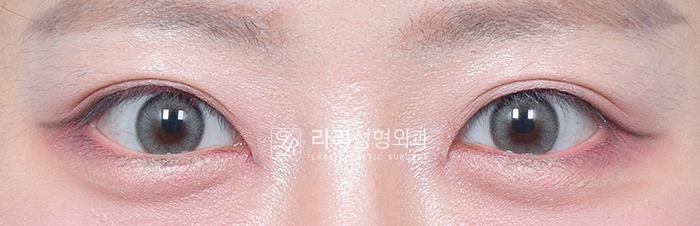 [라리성형외과] 아이홀 꺼짐 있는 눈 파악하고, 윗눈꺼풀 지방이식으로 교정 관련 이미지 5