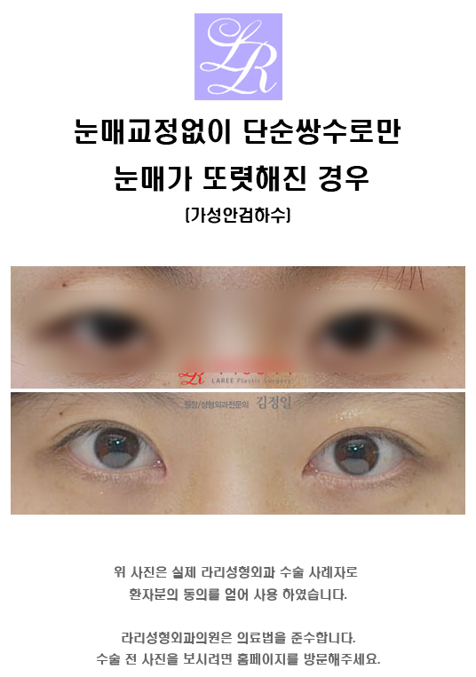 Comparing Swelling After Incisional Ptosis Correction vs. Incisional Double Eyelid Surgery image 5