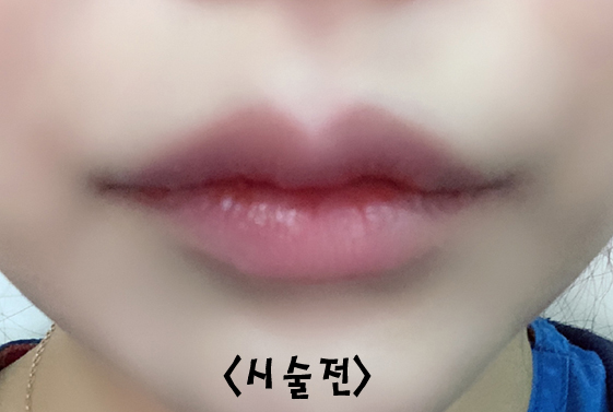 How to Make the Corners of the Mouth Lift Beautifully with Lip Corner Filler image 7