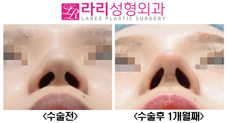 [라리성형외과] 매부리코수술, 무보형물로 자연스럽고 매끈하게 관련 이미지 6