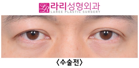 [라리성형외과] 쌍꺼풀없애기 수술 눈안감김(토안)의 원인이 정말 피부절제 때문일까? - 무절제쌍꺼풀없애기 관련 이미지 20
