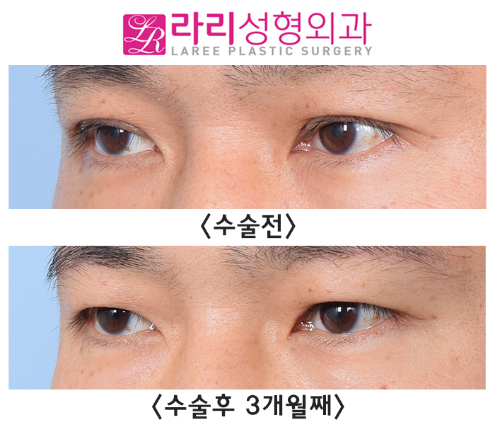 [라리성형외과] 절개 눈매교정 후 급속교정, 6개월 기다리지 않고 일주일 만에 쌍꺼풀없애기 관련 이미지 8
