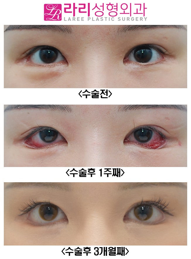 [Lari Plastic Surgery] Revision Lower Blepharoplasty: From Pre- and Post-Op Photos to the Recovery Course with Swelling image 1