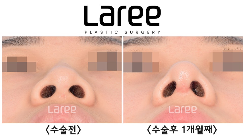 [Lari Plastic Surgery] Hump Nose Surgery Is Performed Naturally Without Implants. (No Implants, Septal Cartilage) image 2