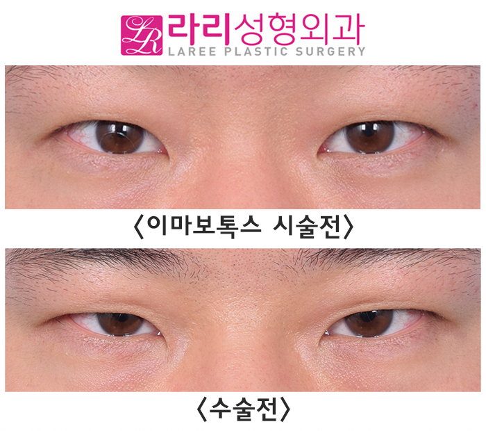 [라리성형외과] 이마미간 보톡스 그리고 절개 눈매교정 수술 전후 사진 단기 경과 관련 이미지 2