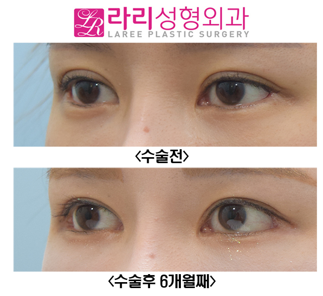 [Rari Plastic Surgery] Eyelid Surgery That Suits Me / Revision Double Eyelid Surgery, Revision Epicanthoplasty, Revision Lateral Canthoplasty image 2