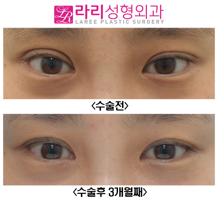[라리성형외과] 쌍꺼풀 짝짝이, 쌍꺼풀 비대칭 교정 수술 전후 관련 이미지 1