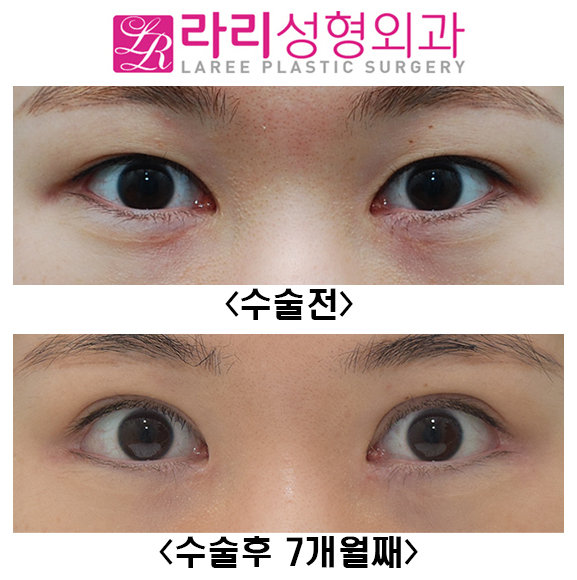 [라리성형외과] 쌍꺼풀재수술, 앞트임복원, 뒤트임재수술, 눈밑지방재배치재수술 전후 관련 이미지 2