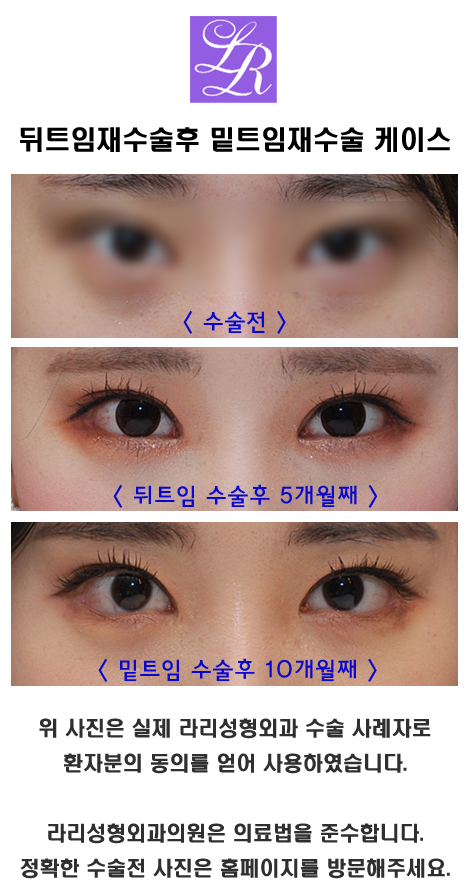 뒤트임재수술 하고나서 밑트임재수술 가능할까 관련 이미지 2