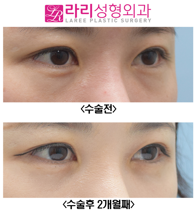 [라리성형외과] 다크서클, 필러? 지방이식? 말고 눈밑지방재배치수술 관련 이미지 3