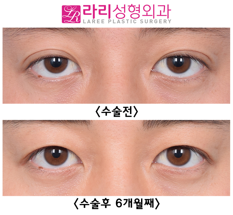 [Rari Plastic Surgery] Double-Eyelid Removal Surgery That Corrects Three-White Eye Without Lower Eyelid Surgery image 2