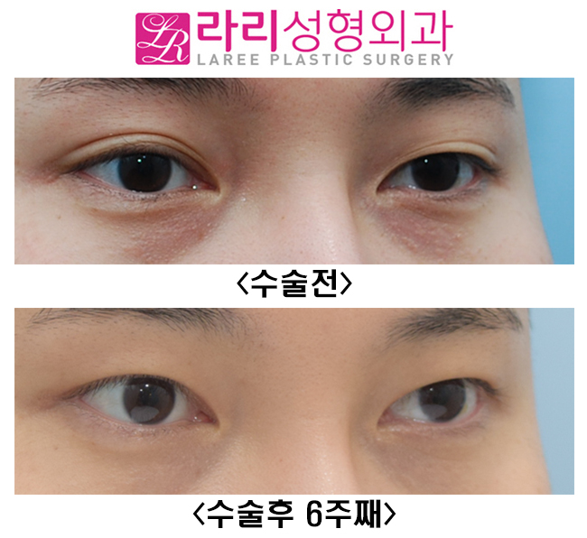 [Lari Plastic Surgery] Short-term progress after surgery to remove a natural double eyelid and make it monolid image 4